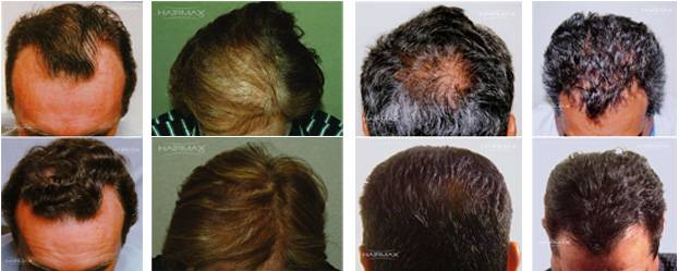 laser hair loss treatment therapy atlanta georgia